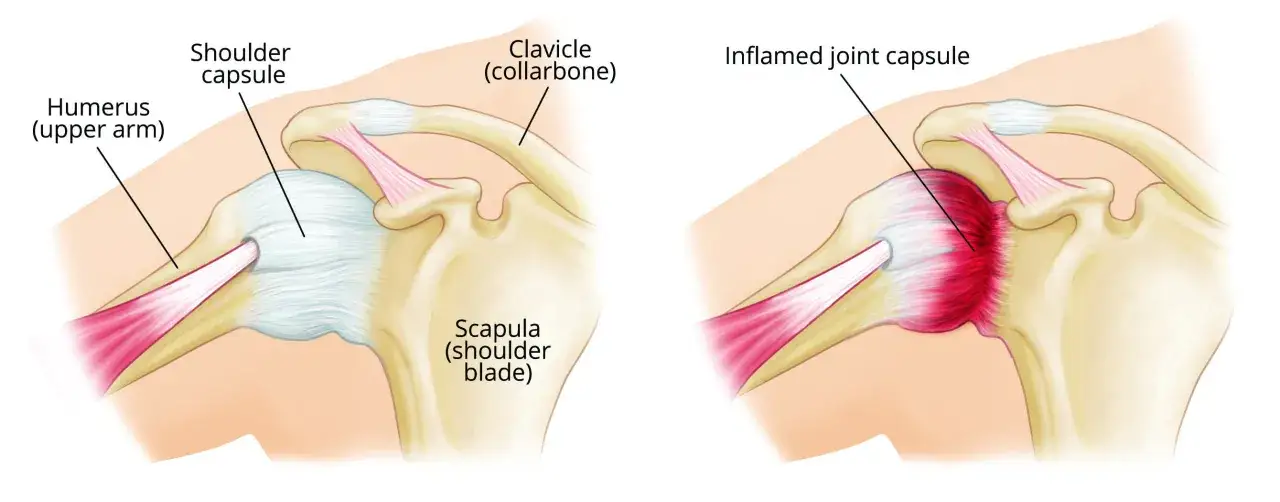 Vergleich von Schulterkapsel und entzündeter Gelenkkapsel. Psychische Ursachen können zu Frozen Shoulder beitragen.