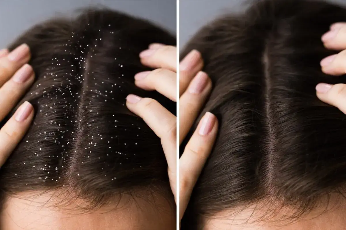 Prima e dopo: capelli con forfora e poi puliti, mostrando l'efficacia dei rimedi naturali per la forfora.