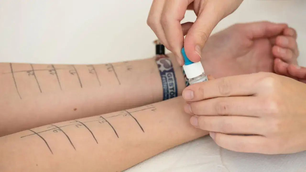 Allergietest am Arm: Kleine Tropfen werden auf markierte Stellen aufgetragen, um eine m&ouml;gliche Kaninchenallergie zu diagnostizieren.