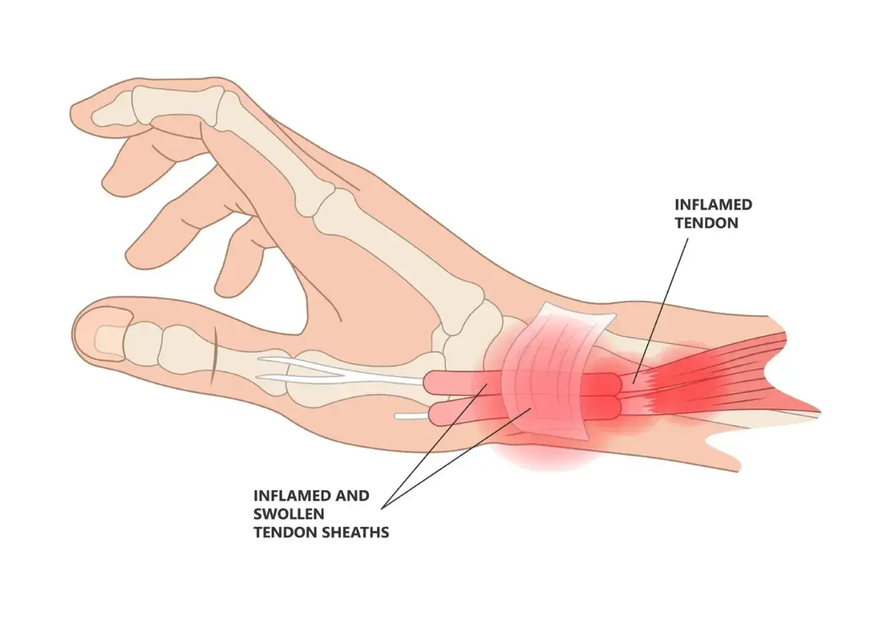 Illustrazione anatomica che mostra il **dolore al palmo della mano sotto il pollice** causato da tendini e guaine tendinee infiammati e gonfi.