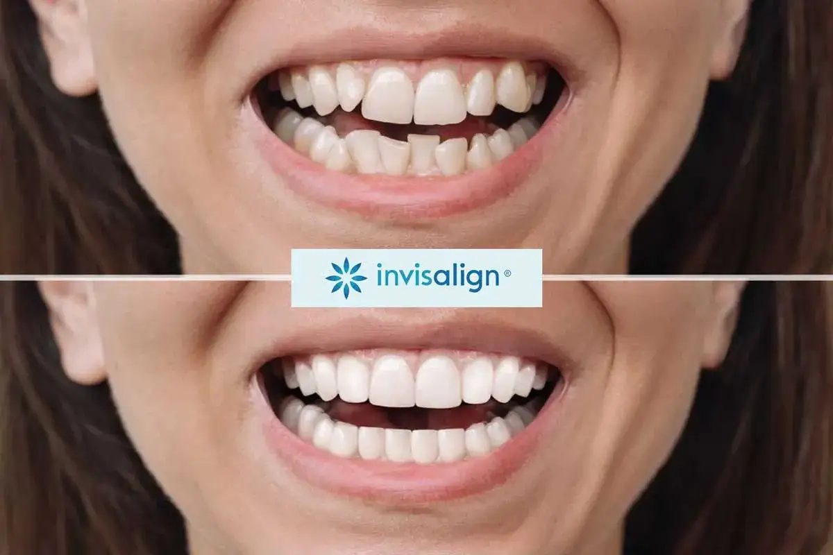 Przed i po: krzywe zęby wyprostowane dzięki Invisalign. Dowiedz się, jak wyprostować zęby bez aparatu.