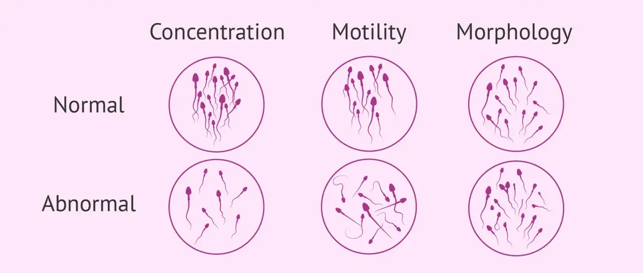 Ilustraci&oacute;n compara concentraci&oacute;n, motilidad y morfolog&iacute;a de espermatozoides normales y anormales. &iquest;Cu&aacute;ntos espermatozoides hay en una eyaculaci&oacute;n?