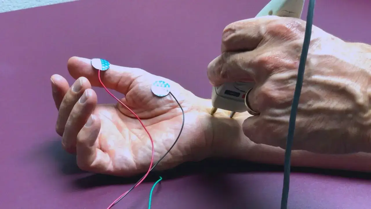 Badanie EMG dłoni z elektrodami na palcach i nadgarstku. Urządzenie stymuluje nerwy, pomagając zdiagnozować problemy.