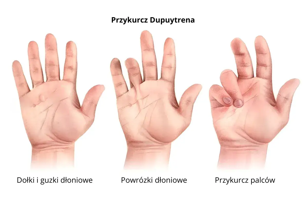 Trzy dłonie ilustrują postępujące stadia przykurczu Dupuytrena: od niewielkich guzków, przez powrózki, aż po zgięte palce.