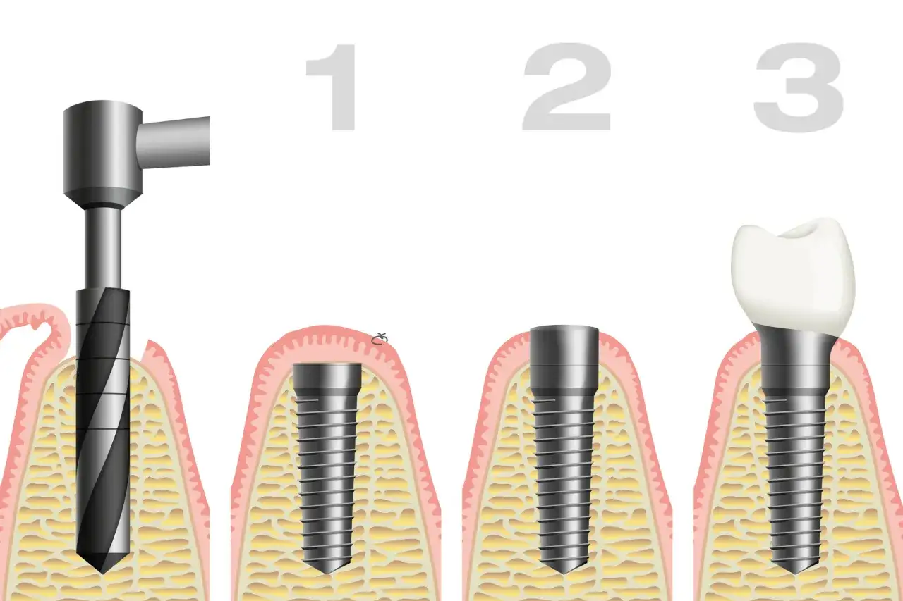 Implant zęba schemat budowy