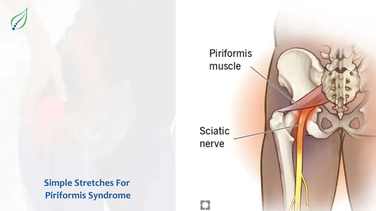 Anatomía de la pelvis y el nervio ciático, mostrando cómo el músculo piriforme puede comprimirlo, causa común del síndrome piriforme.