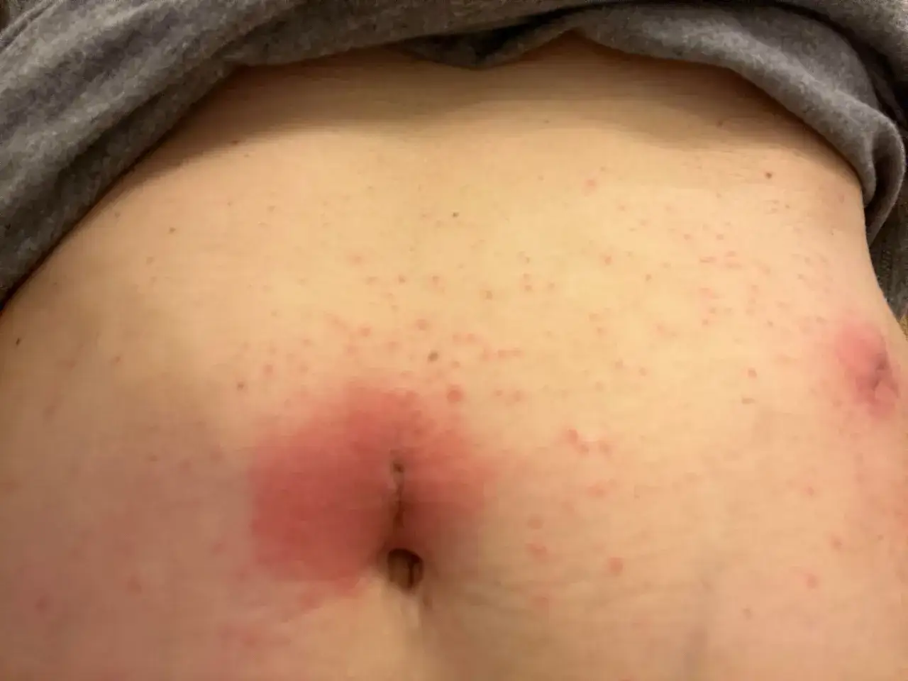 Ventre irrit&eacute; avec &eacute;ruption cutan&eacute;e rouge, possible allergie fil resorbable.