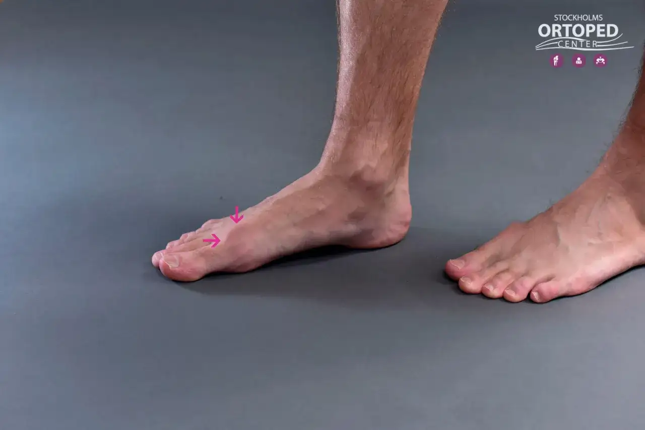 Foten visar tecken p&aring; hallux rigidus erfarenheter, med en stel stort&aring;led markerad med rosa pilar.