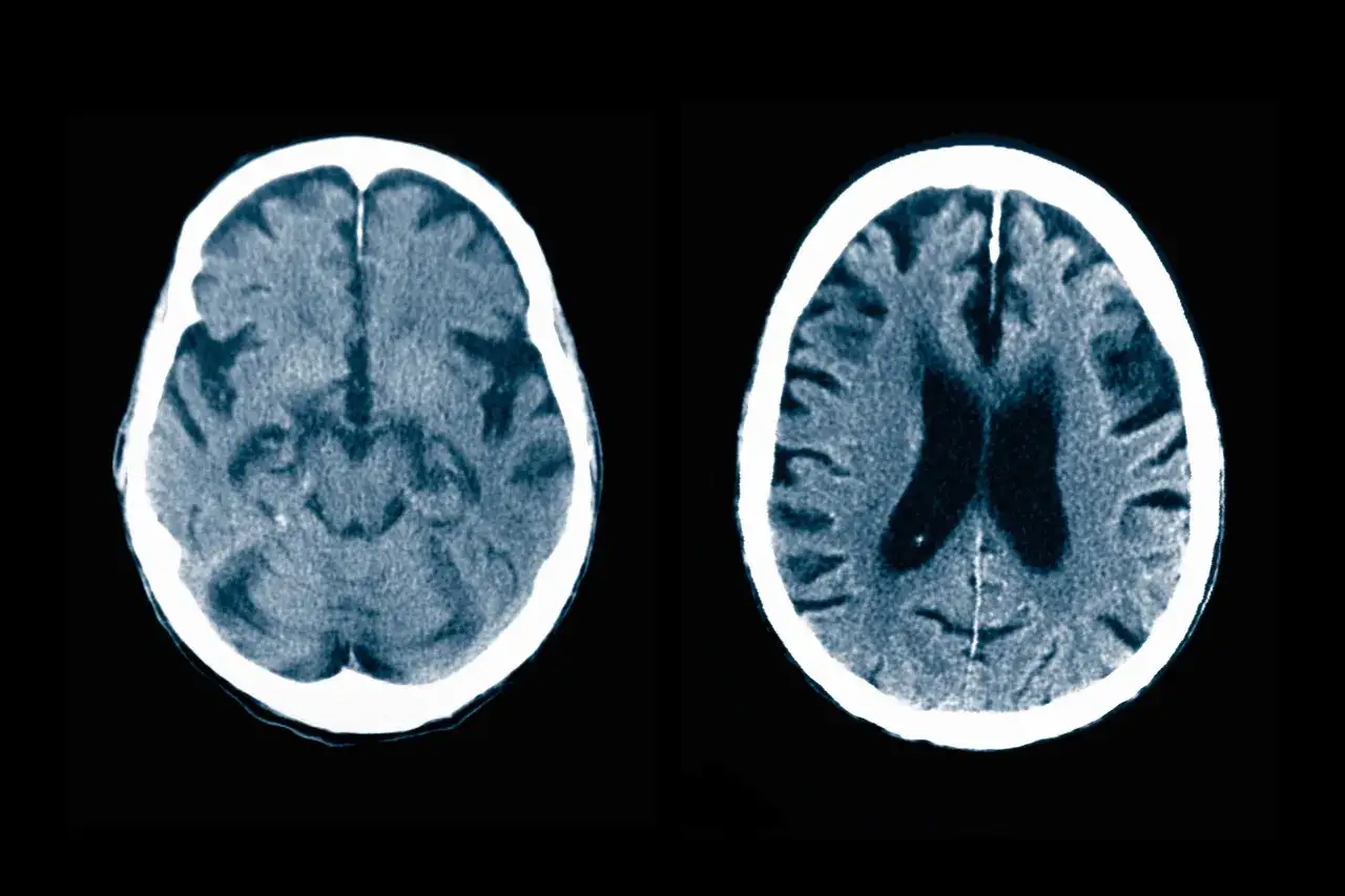 Scansione cerebrale che mostra segni di decadimento cognitivo. Le immagini evidenziano atrofia cerebrale e dilatazione dei ventricoli.