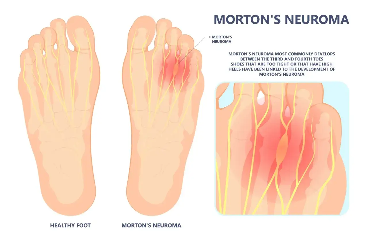 Illustration zeigt einen gesunden Fuß und einen Fuß mit Morton-Metatarsalgie, wo ein Nerv zwischen den Zehen entzündet ist.