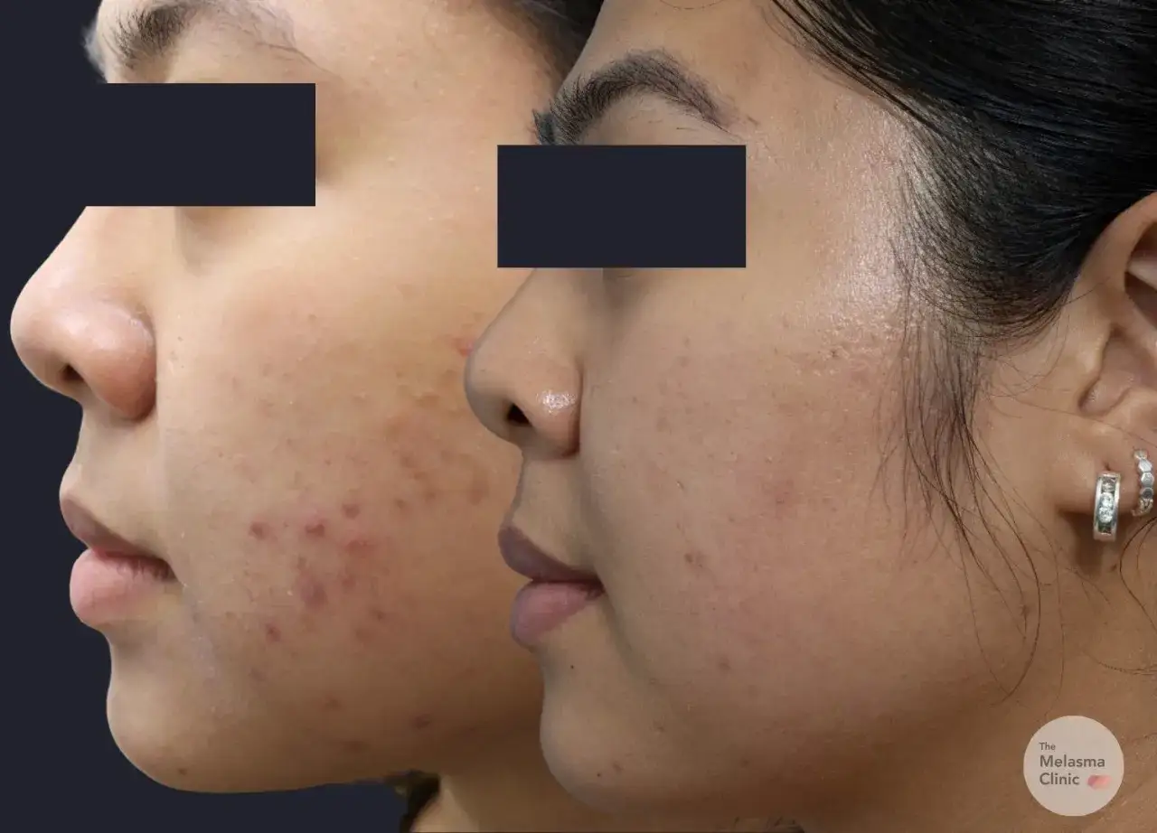 Prima e dopo: pelle con macchie da acne trattata da dermatologo. Miglioramento visibile.