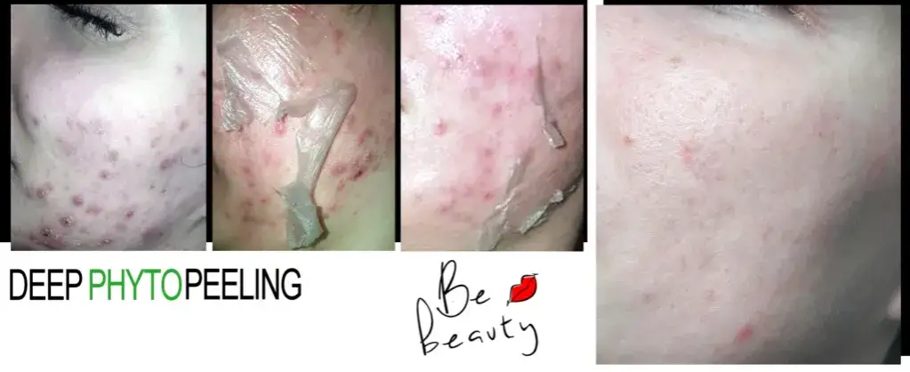 Zdjęcie Gdzie kupić deep phyto peeling i uniknąć nieefektywnych produktów