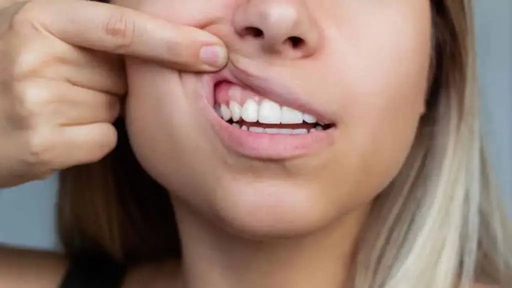Zdjęcie Ropa na dziąśle: jak usunąć? Domowe sposoby i wizyta u dentysty