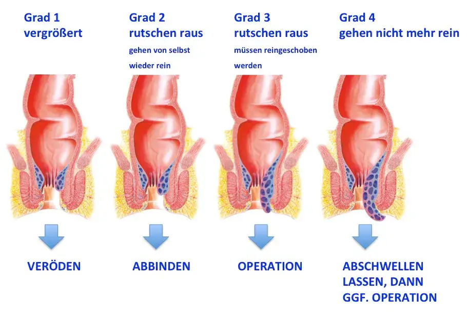 Zdjęcie Hämorrhoiden Symptome: Erkennen Sie die Anzeichen und vermeiden Sie Schmerzen