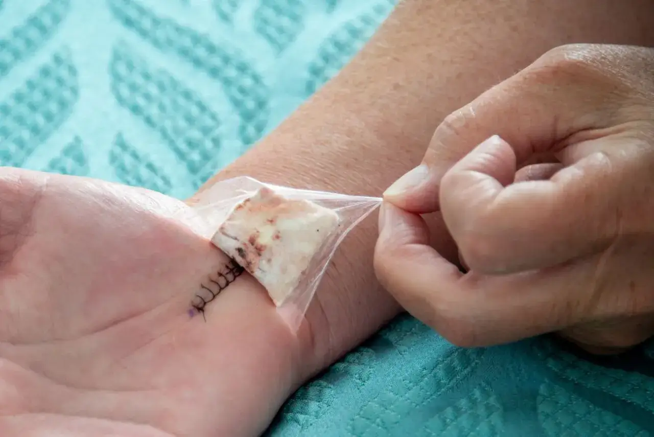 Zdjęcie Skutki uboczne po operacji cieśni nadgarstka, które mogą Cię zaskoczyć