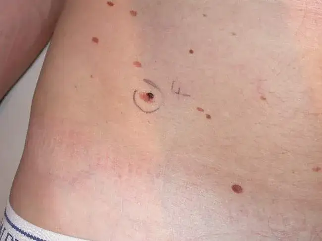 Zdjęcie Co oznacza, gdy pieprzyk boli jak pryszcz? Sprawdź to teraz