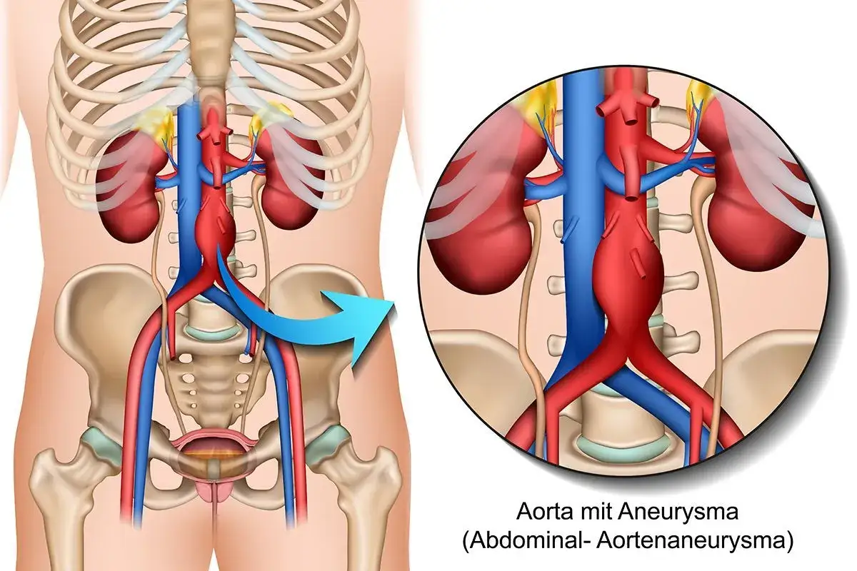Zdjęcie Aneurysma Symptome Bauch: Warnsignale, die Sie nicht ignorieren sollten