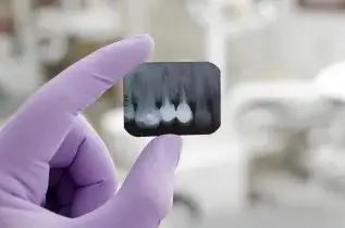 Zdjęcie Ile naprawdę kosztuje plomba u dentysty i jak uniknąć wysokich rachunków
