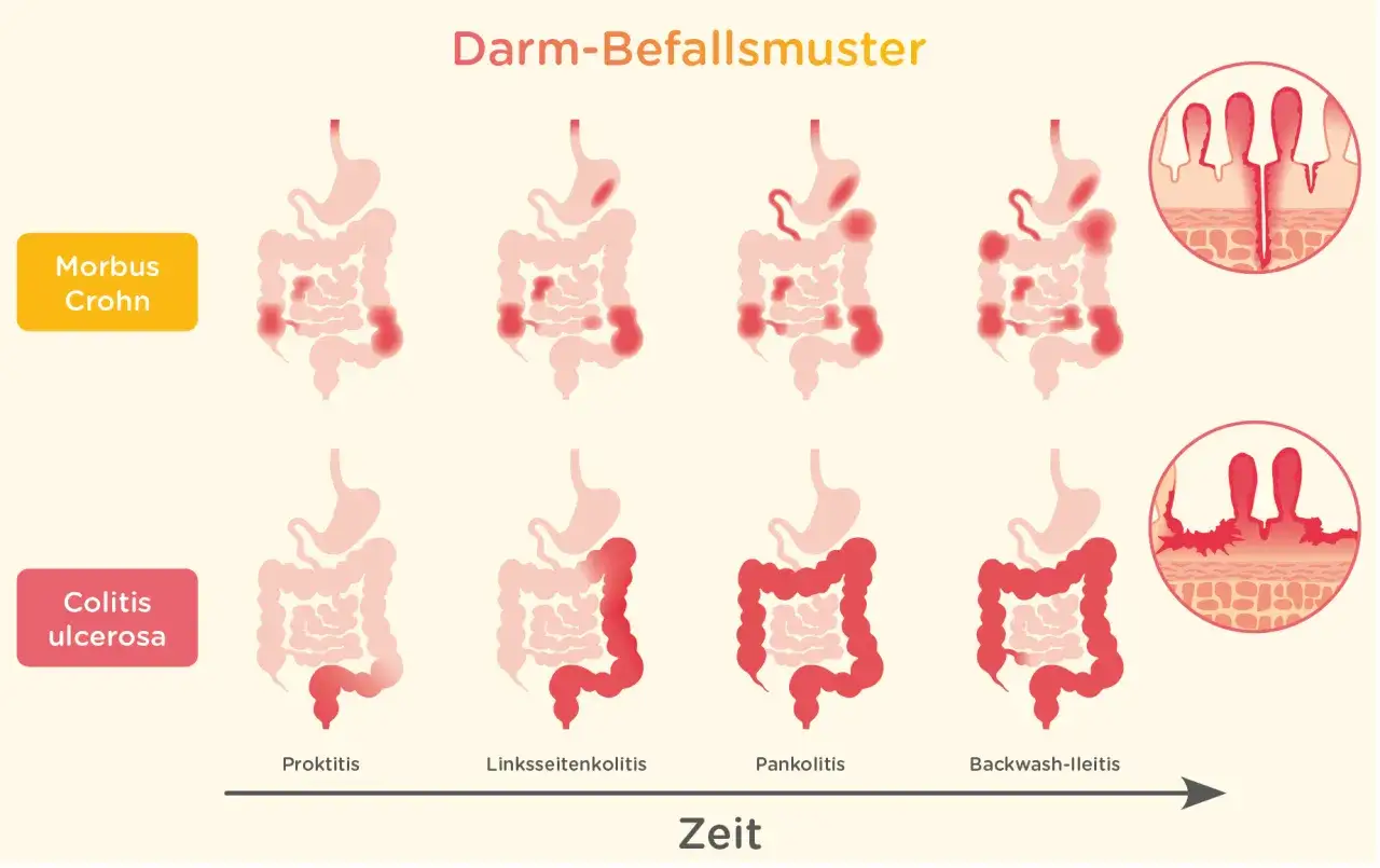 Zdjęcie Colitis ulcerosa Symptome: Warnsignale, die Sie nicht ignorieren sollten