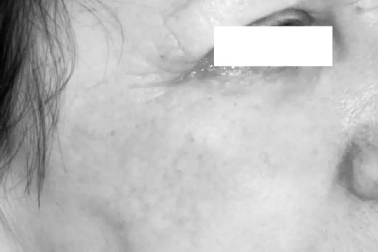 Zdjęcie Peeling fenolowy ile się goi: co musisz wiedzieć o regeneracji skóry