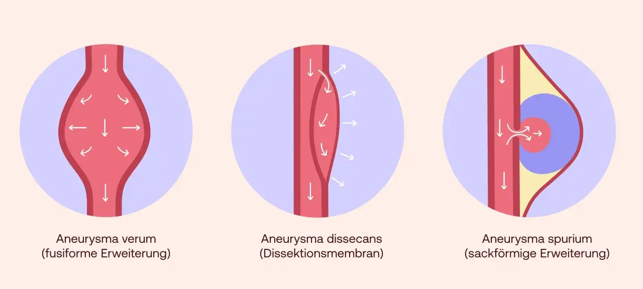 Zdjęcie Aneurysma Bauch Symptome: Warnzeichen, die Sie nicht ignorieren sollten