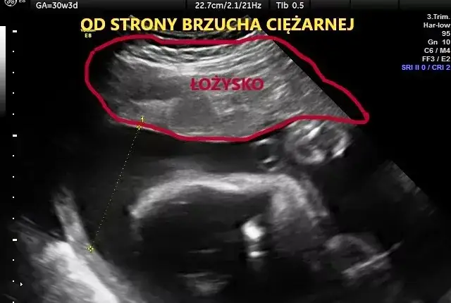 Zdjęcie Jak oczyścić łożysko w ciąży i uniknąć poważnych problemów zdrowotnych