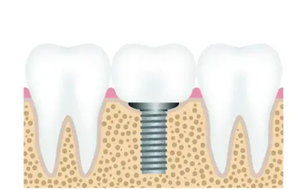 Zdjęcie Ile po dentyście nie można jeść? Kluczowe informacje dla pacjentów