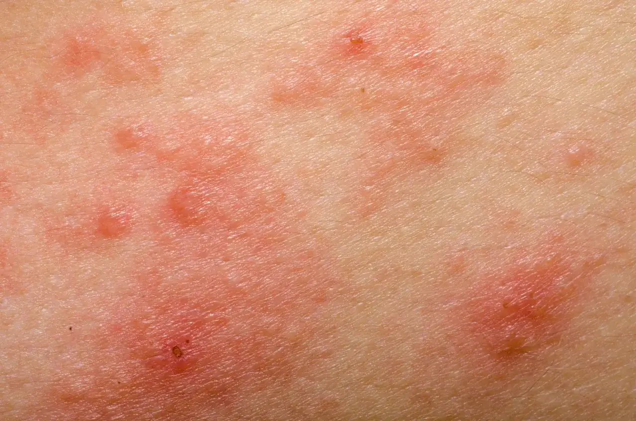 Zdjęcie Alergia na gluten objawy: jak rozpoznać niebezpieczne reakcje