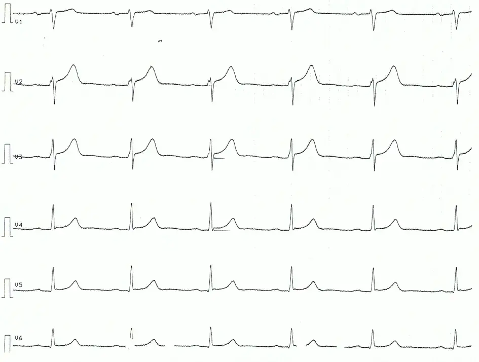 Zdjęcie Myokarditis Diagnostik EKG: EKG-Befunde verstehen und richtig deuten