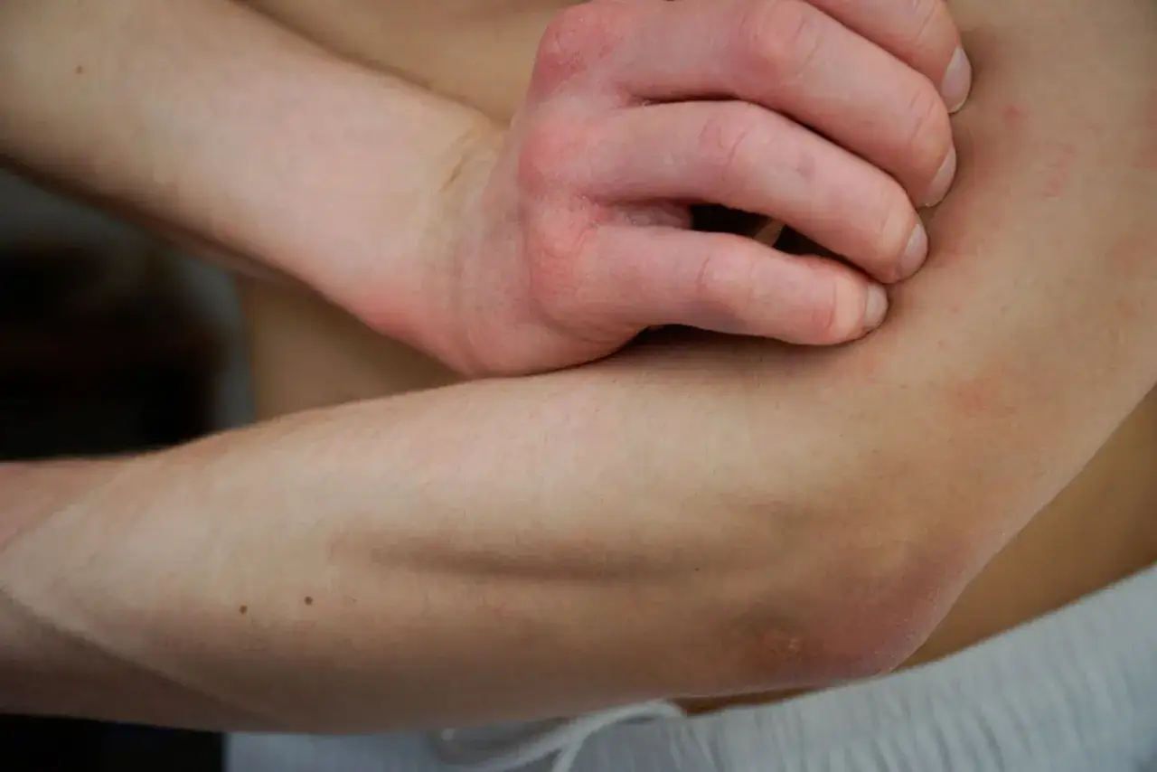 Zdjęcie Czy lawenda uczula? Objawy alergii i jak ich uniknąć