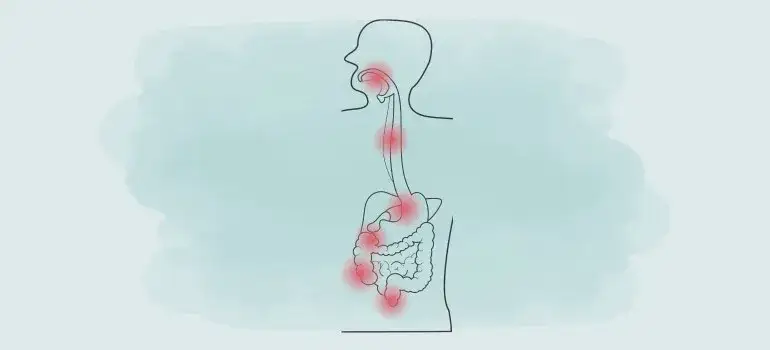Zdjęcie Morbus Crohn Symptome: Erkennen Sie die alarmierenden Anzeichen