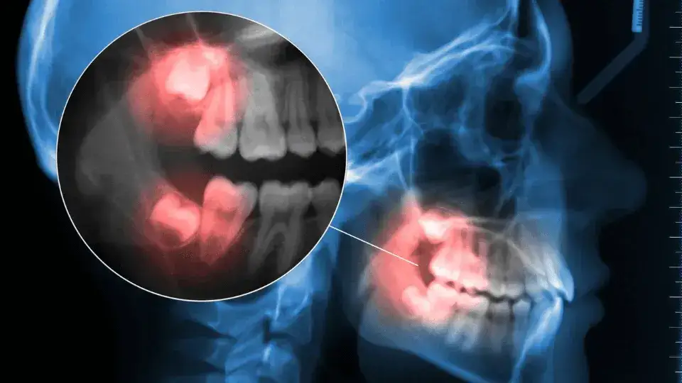 Zdjęcie Ósemki: Kiedy rosną? Objawy, ból i kiedy iść do dentysty