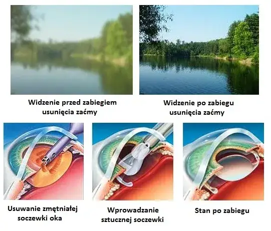 Zdjęcie Czy operacja zaćmy jest refundowana? Sprawdź, co musisz wiedzieć