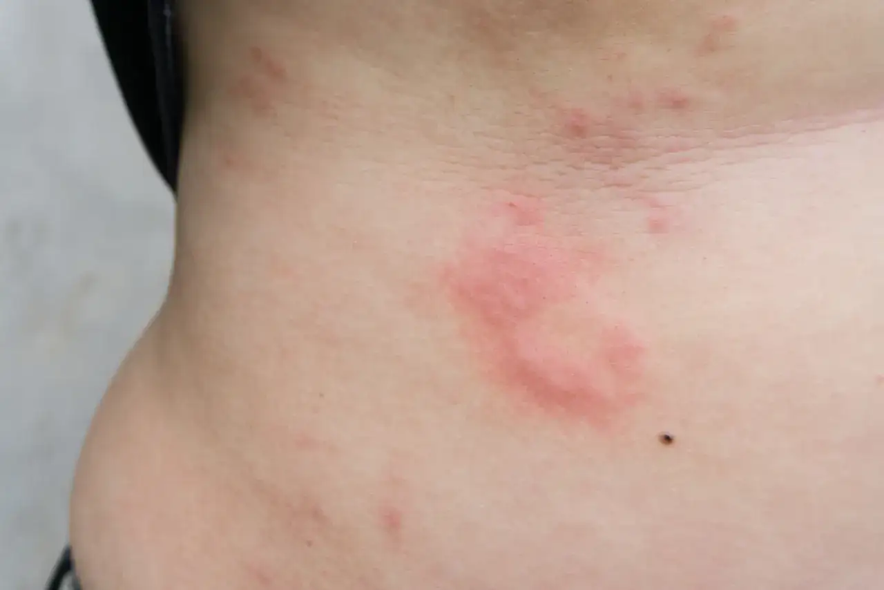 Zdjęcie Czy kurkuma uczula? Objawy alergii i ryzyko reakcji alergicznych