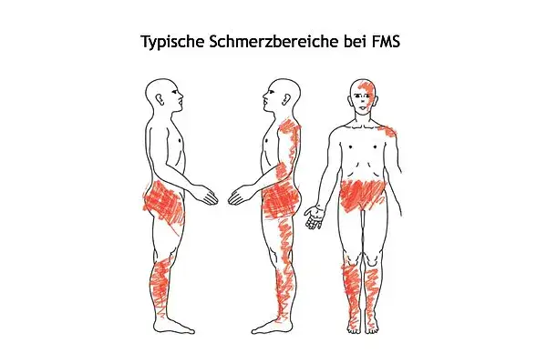Arzt erklärt Patientin medikamentöse Behandlung Fibromyalgie