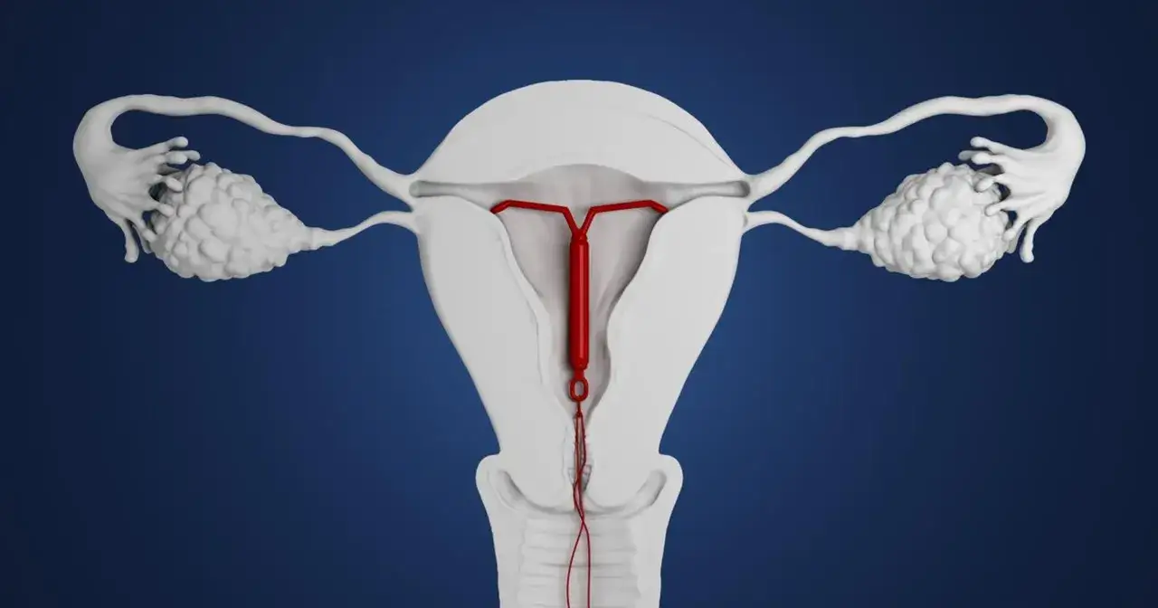 Anatomia kobieca z widoczną wkładką domaciczną. Wkładka jest w kształcie litery T, w kolorze czerwonym, umieszczona w macicy. Wok&oacute;ł macicy widoczne są jajowody i jajniki.
