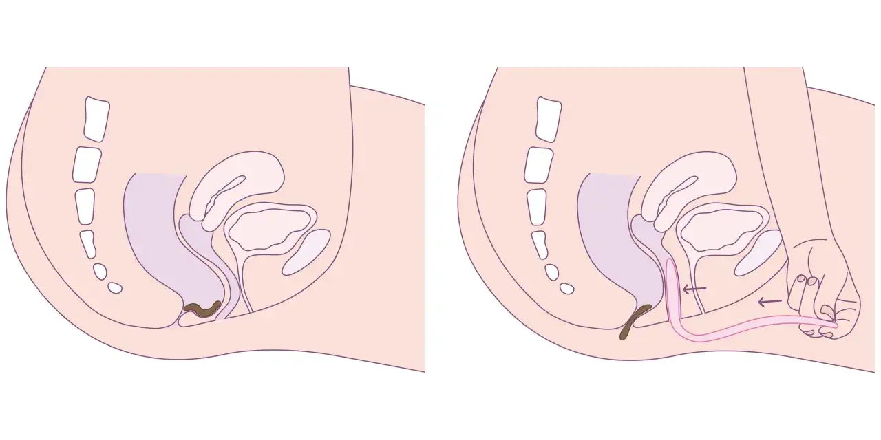 Illustration d'un exercice pour rectocèle : le rectum sortant est repoussé.