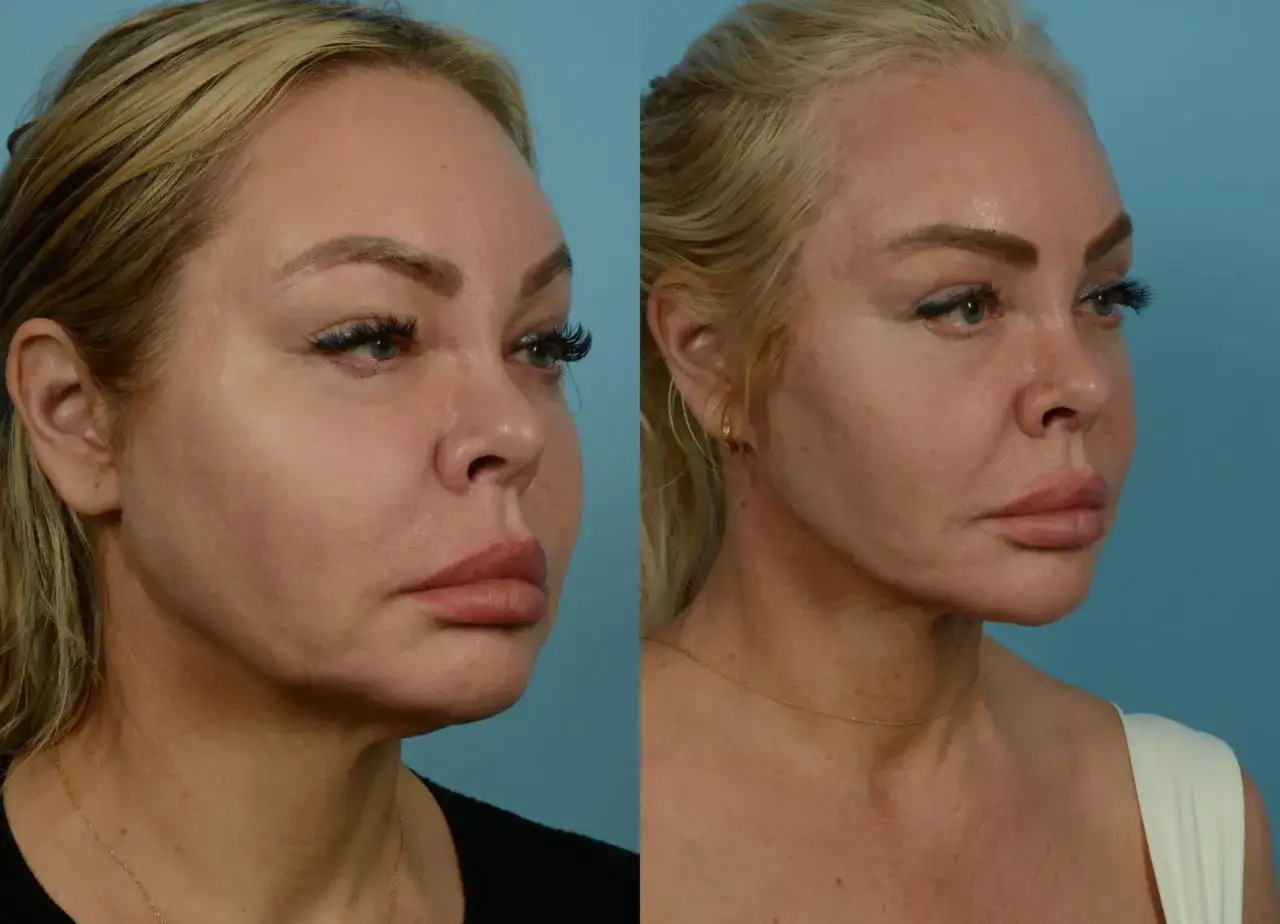Przed i po zabiegu face lifting. Widoczna poprawa owalu twarzy i napięcie skóry.