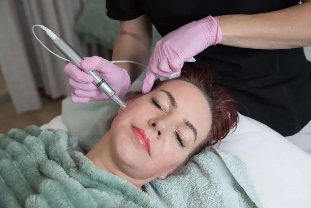 Professionista esegue trattamento viso microneedling su cliente rilassata.