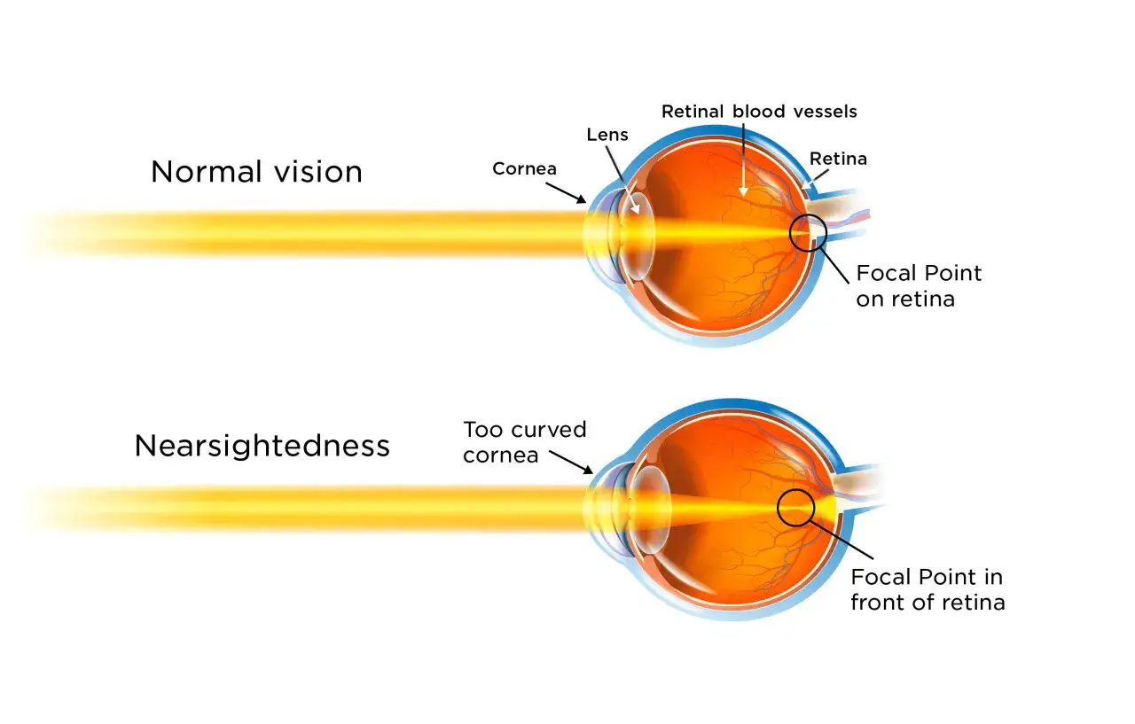 Confronto tra visione normale e occhio miope: la luce si focalizza sulla retina o davanti ad essa.