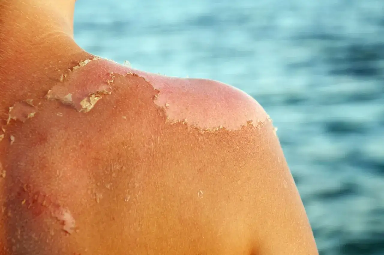 Sk&oacute;ra ramienia po opalaniu, z widocznym łuszczącym się nask&oacute;rkiem. To naturalny peeling beztłuszczowy po zbyt długim pobycie na słońcu.