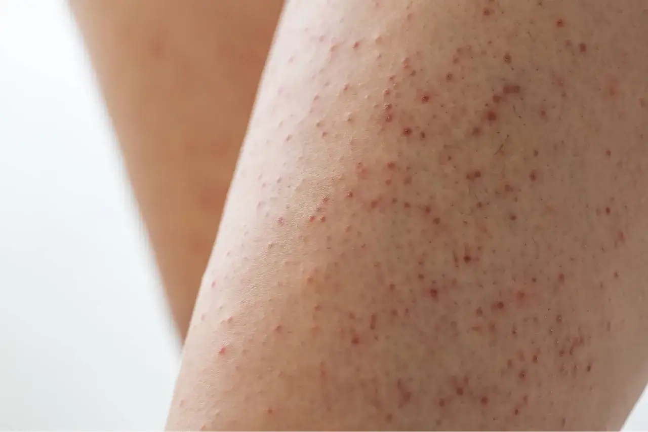 Gros plan sur une peau présentant de petites bosses rouges et rugueuses, typiques de la kératose pilaire.
