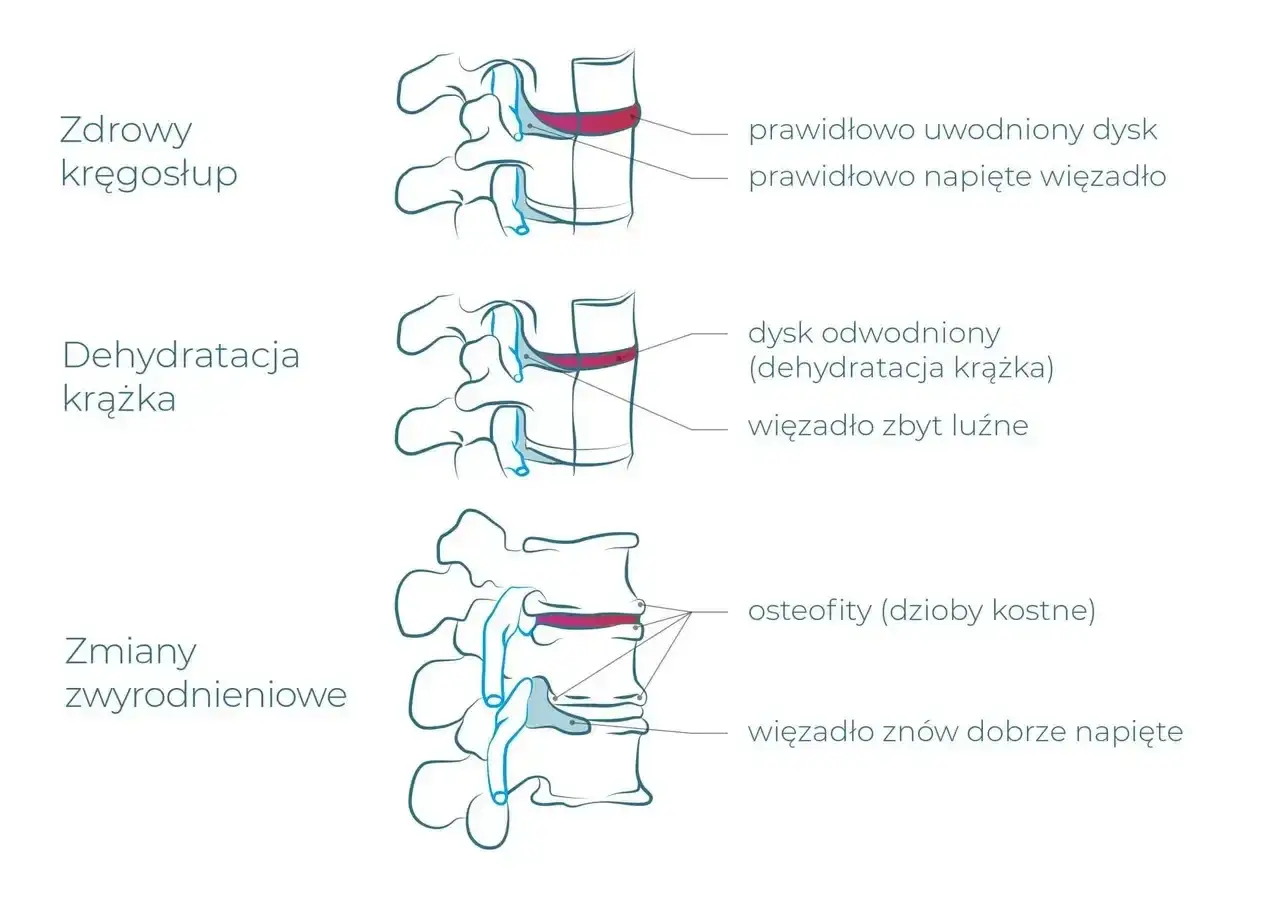 Ilustracja pokazuje postęp zwyrodnienia kręgosłupa: od zdrowego dysku, przez jego odwodnienie, aż do zmian zwyrodnieniowych z osteofitami.