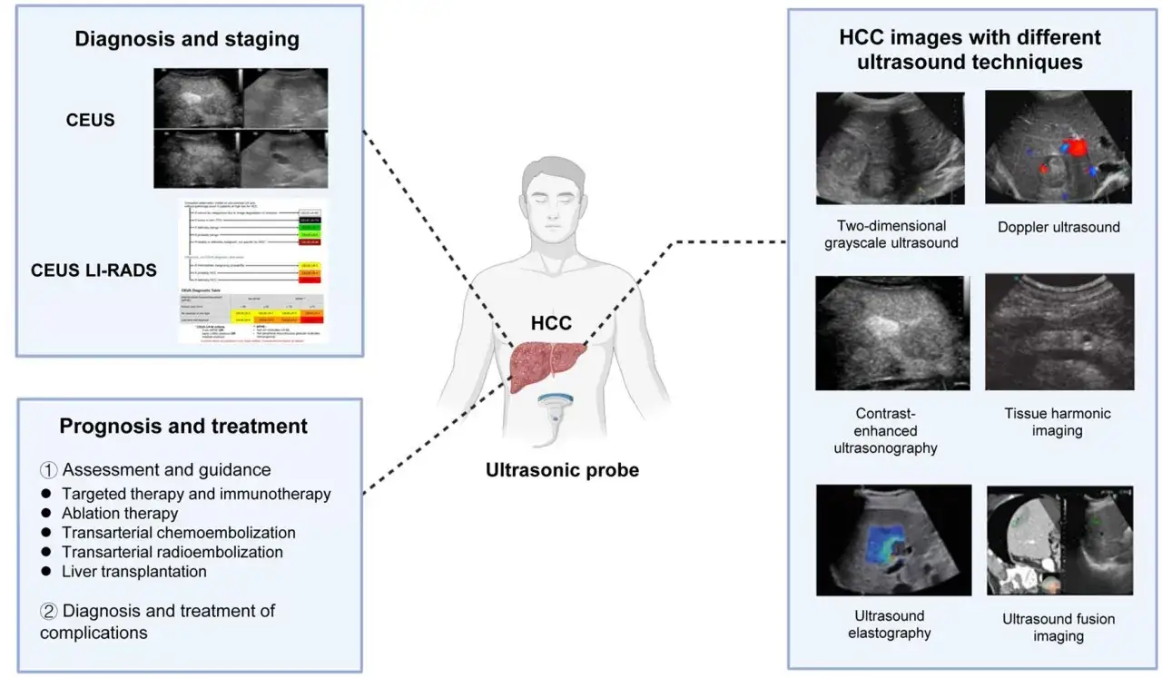 Schema zur Diagnose, Prognose und Behandlung von Leberkrebs (HCC). Verschiedene Ultraschalltechniken zeigen, dass Leberkrebs heilbar ist.