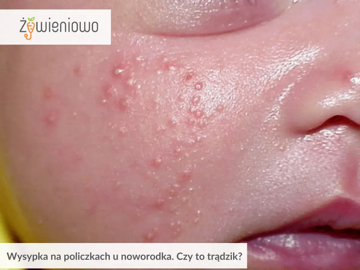 Skóra niemowlaka z wypryskami. Czy to trądzik niemowlęcy, czy może skaza białkowa?