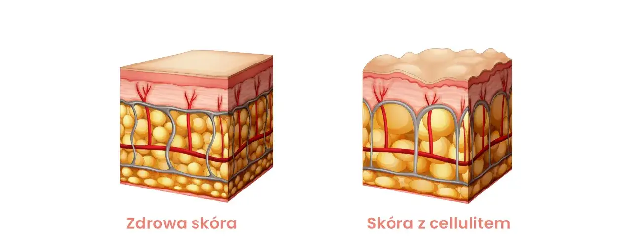 Kobieta zamyślona, patrząca na swoje uda, z delikatnym cellulitem, w lustrze