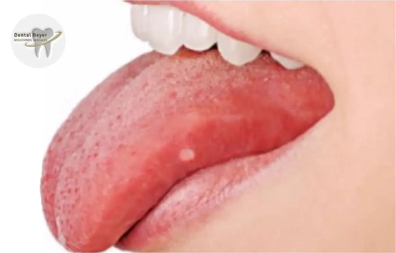 Lengua con peque&ntilde;as protuberancias rojas y una llaga blanca, mostrando por qu&eacute; salen granos en la lengua.