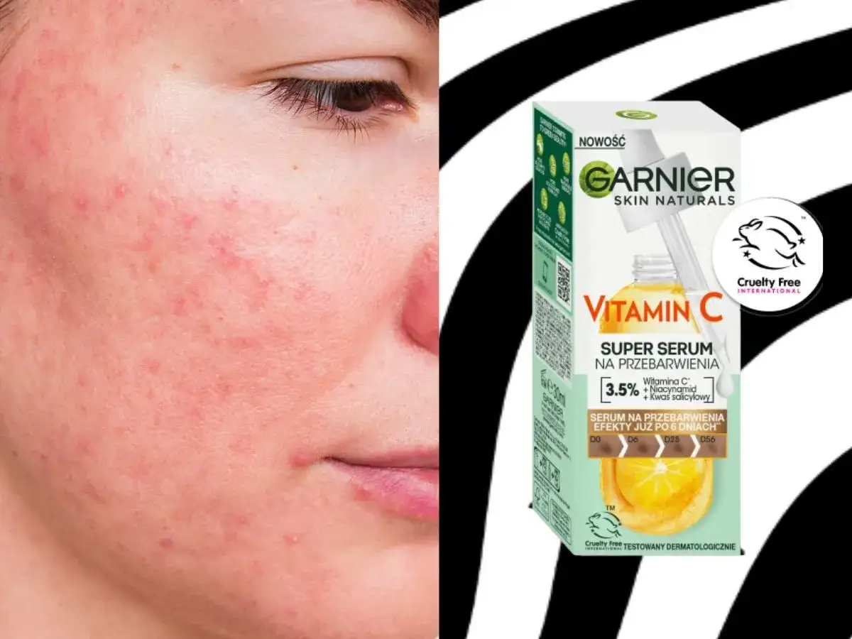 Skóra z przebarwieniami i zaczerwienieniami obok serum Garnier z witaminą C na przebarwienia.