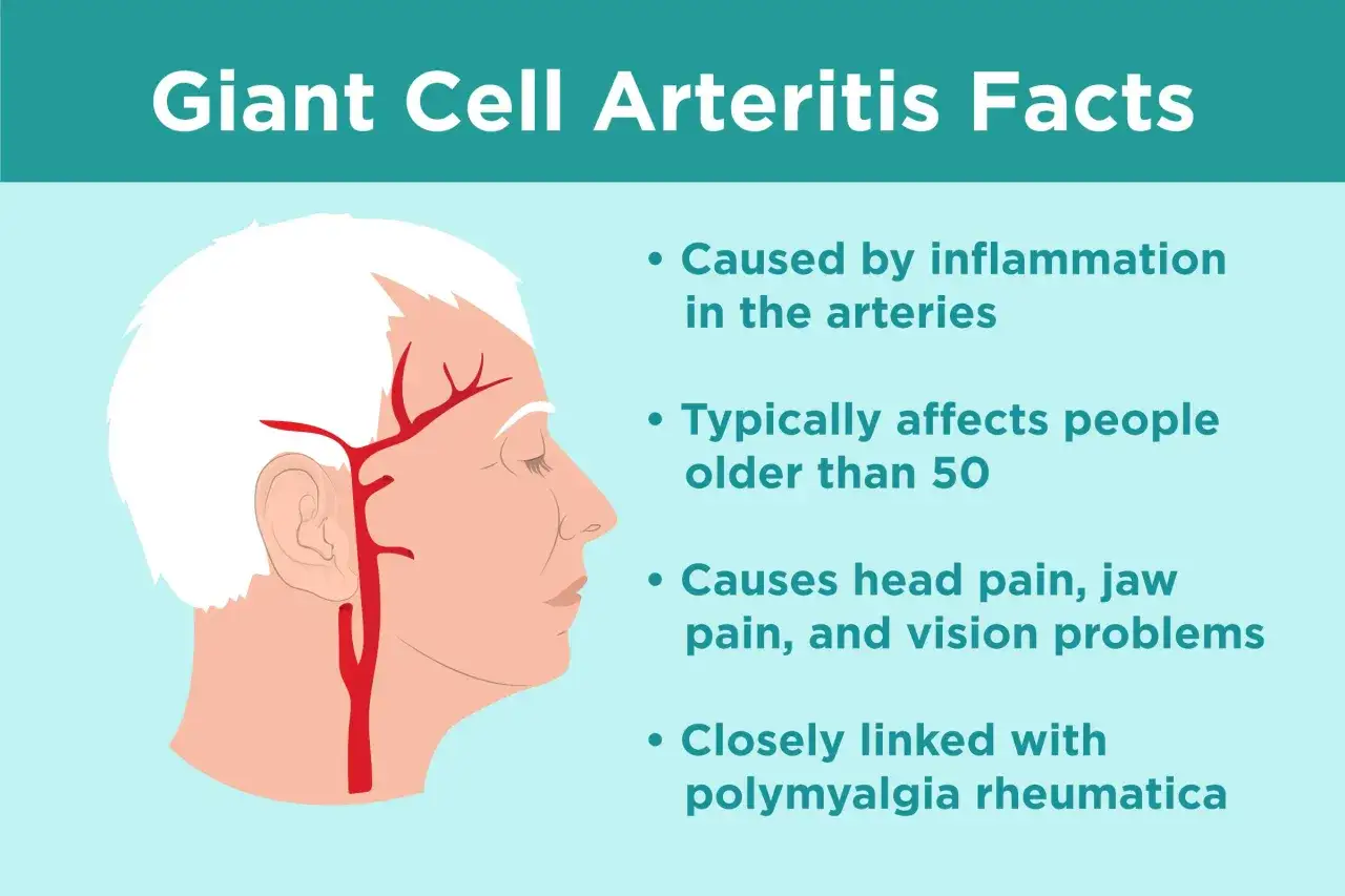 Kopf- und Kiefernschmerzen, Sehst&ouml;rungen: Fakten zu **Arteriitis temporalis**, einer Entz&uuml;ndung der Arterien, die oft &auml;ltere Menschen betrifft.