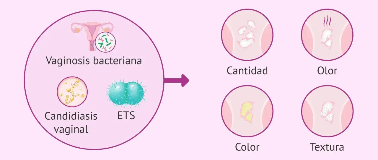 Ilustraci&oacute;n sobre vaginosis bacteriana, candidiasis vaginal y ETS. Muestra s&iacute;ntomas como cantidad, olor, color y textura del flujo.